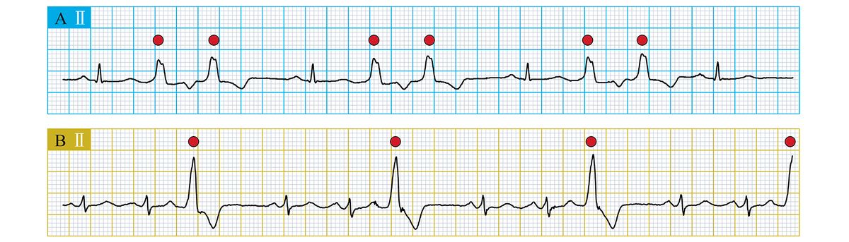 La imagen muestra dos trazados electrocardiográficos, A y B, con marcadores rojos en los picos.