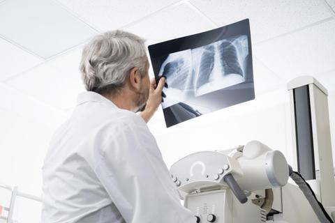 Un médico observa una radiografía de los pulmones.